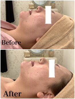 スペチアーレ 夙川/炭酸ピーリングで美肌美人！