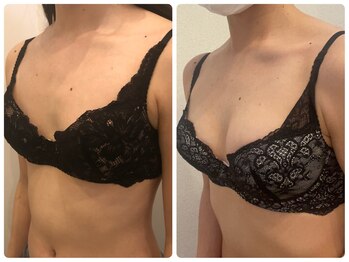 プリマ(prima)/バストアップ症例