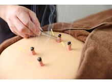 さかえ鍼灸治療院 整体院/温灸施術【鍼灸】