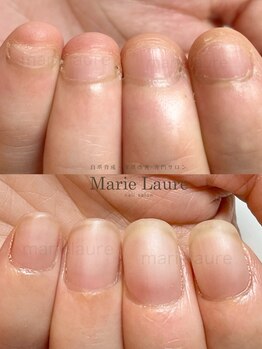 マリーロール 梅田店(Marie Laure)/自爪育成/深爪矯正/ネイルケア