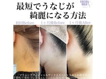エリス(ELISSE)/うなじwaxと光脱毛