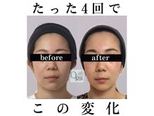 キュープ 広島店(Qpu)の雰囲気（回数を重ねる毎にお顔が整い変化します）