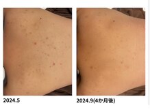 オーシャンブルー 福岡店(OCEAN BLUE フェイシャル&ボディ)/ニキビケア(背中のニキビケア)