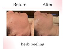 サロンツキ(salon tuki)/ハーブピーリング症例/徳島