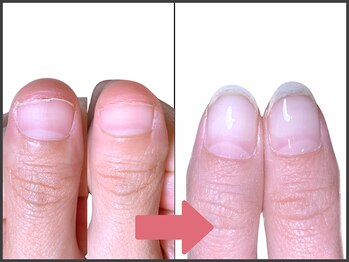 アモ 坂戸(’Amo)/深爪矯正・自爪育成 坂戸/北坂戸