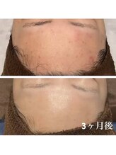 ベベアート(BEBEART)/REVI陶肌ハーブピーリング