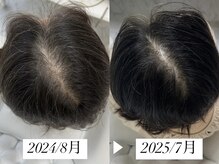 ミランサ ギンザ(MIRANSA GINZA)/【B/A】ACスカルプケア