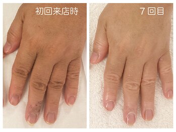 キレイテ 福岡天神店/50代/5回目【大名ハンドケア】