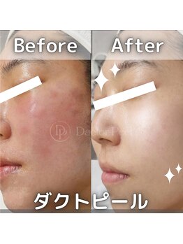 セカンドフロア バイ ブレスト ハコダテ(2nd floor by BLESSED HKD)/第五世代ピーリング