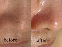 ウィズルーチェ 神栖店(with luce)/毛穴洗浄１回効果★鼻黒ずみ毛穴