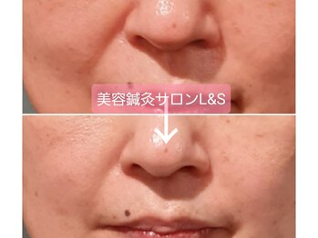 エルアンドエス(L&S)/ほうれい線改善1ヶ月キープ！