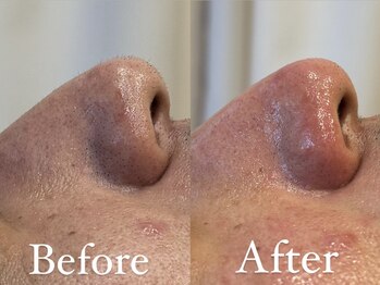 ザ パールズ(The Pearls)/鼻の産毛も艶肌WAXでスッキリ！