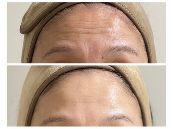 ロワフーレ/おでこのシワも目立ちにくくなる