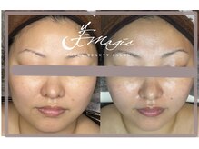 ビーマジック(美magic)/レモンボトル