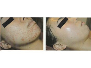 ガネェーシャ(Ganesha)/水光ピーリングビフォアフ