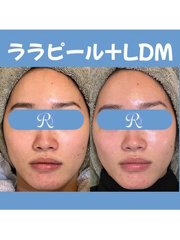 リスキン(Reskin)/《ハリツヤ、小顔》