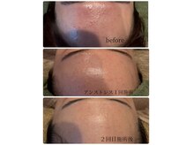 エミィシア(Emisia)の雰囲気（少ない施術回数でもここまで変わる◎）