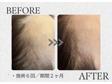 リコロン 銀座(Re:)/産後の抜け毛改善に♪