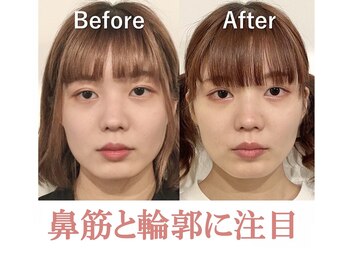 ラプリボヤージュ 藤沢店(Raplit)/ 隆鼻＋輪郭矯正40分10回コース