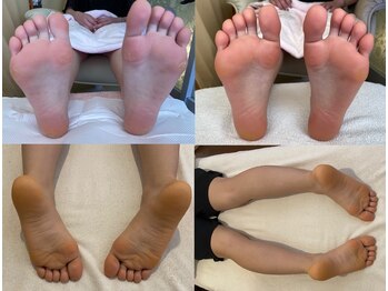 角質育成ケアで足裏,カカトケア