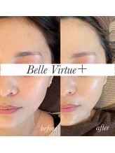ベルバーチュプラス(Belle Virtue +)/カーボキシー