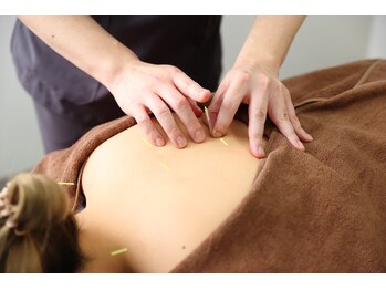 さかえ鍼灸治療院 整体院/5.鍼による施術【鍼灸】