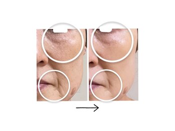 ロワフーレ/気になる目の下のシミやくすみに