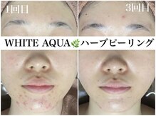 ホワイトアクア 錦糸町店(WHITE AQUA)/ハーブピーリング/毛穴/錦糸町