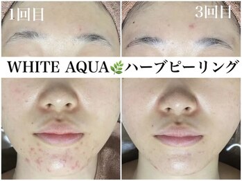 ホワイトアクア 錦糸町店(WHITE AQUA)/ハーブピーリング/毛穴/錦糸町