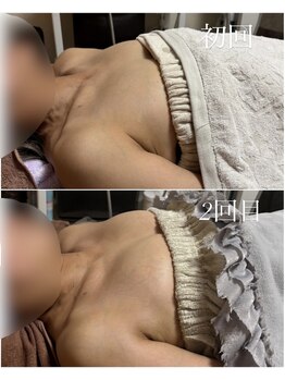 エース(A)/立体バスト