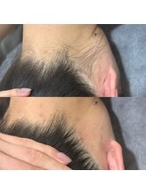 エリクサー 太田店(Elixir)/レディース脱毛