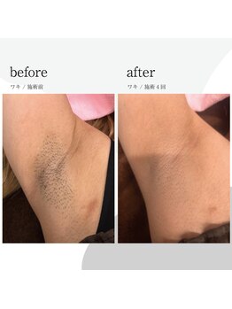 コンフォート ヤマガタ イン ショウナイ(comfort yamagata in shonai)/ワキ脱毛before/after