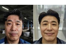 ICDスキンスタジオ 新宿三丁目(ICD-skin studio)/Before-After