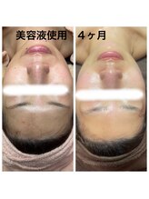 ヒール(heal)/美容液使用4ヶ月変化