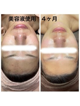 ヒール(heal)/美容液使用4ヶ月変化