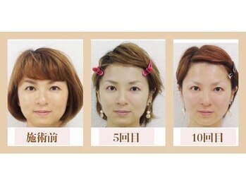 ビキュール 表参道店(美cuol)/丸顔・エラ張りさんタイプ