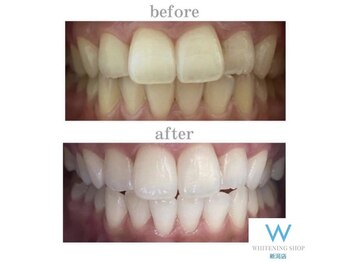 ホワイトニングショップ 新潟店/ホワイトニングビフォーアフター