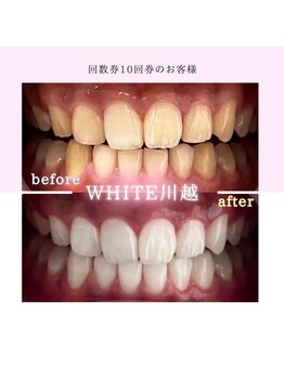 ホワイト 川越店(WHITE)/歯のbefore→after