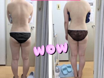 エクラ(Eclat)/背中矯正/姿勢改善/ダイエット