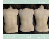 京 鍼灸院 整体院/カッピング前の写真の経過