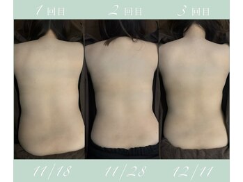 京 鍼灸院 整体院/カッピング前の写真の経過