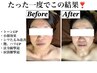 【毛穴/シミ/法令線/たるみ/乾燥肌/ニキビ・跡】選べるフェイシャル　60分