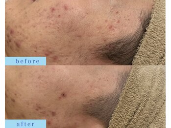 アフロディーテ(APHRODITE)/ビフォーアフター