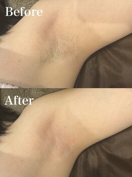 ジョエルワックス 沖縄那覇店(JOELLE WAX)/夏に向けて脱毛スタート！！