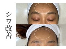 エトレ(etre)/毛穴/しわしみ/エステピーリング