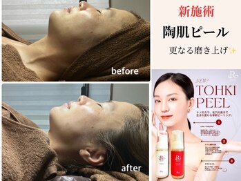 ベリル(BERYL)/陶肌ピールで艶々お肌に!