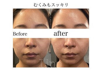 リノ(Lino)/むくみもスッキリ