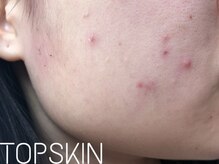 トップスキン 表参道(TOPSKIN)/思春期や生理周期のニキビも改善