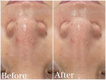 サロンドフェイス(Salon de Faith)/ハーブピーリング