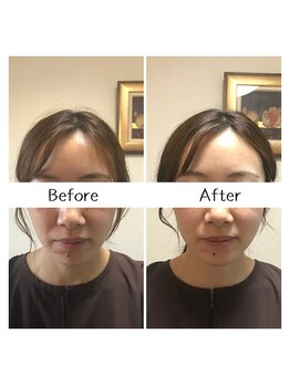 リー(Re)/例【美容鍼】ビフォーアフター